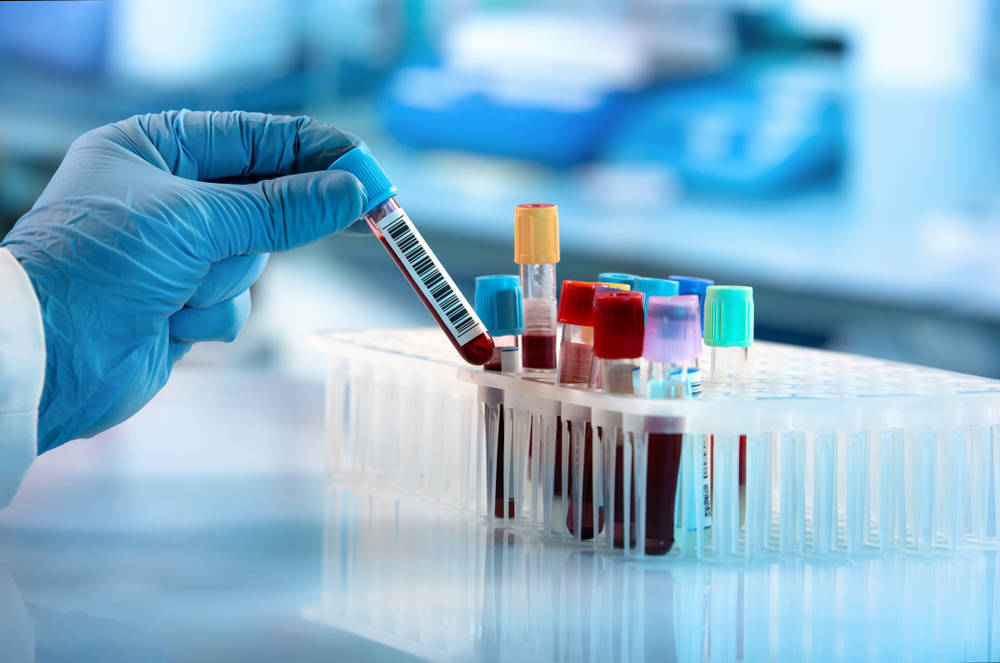 doctor-hand-taking-blood-sample-tube-HbA1c-Blood-Test-tests-welzo